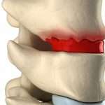 Degenerative-Disc-Disease
