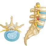herniatic disc treatment